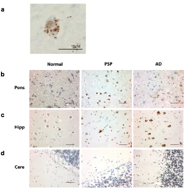 Figure 2.2 peIF2α is activated in PSP, AD, and normal brain. a. Example of a cell with peIF2α puncta in the pons of a PSP case