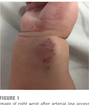 FIGURE 1Image of right wrist after arterial line access 