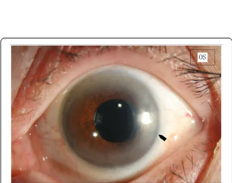 Fig. 1 Steps of Procedure. a. 26G needle with its bent tip was kept horizontal to avoid snagging the iris