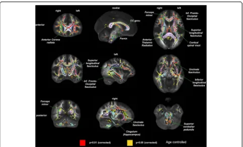 Fig. 2 Difference in white matter damage assessed by mean diffusivity in prevalent hemodialysis patients (FA (n = 34) versus controls without kidneydisease (n = 26)