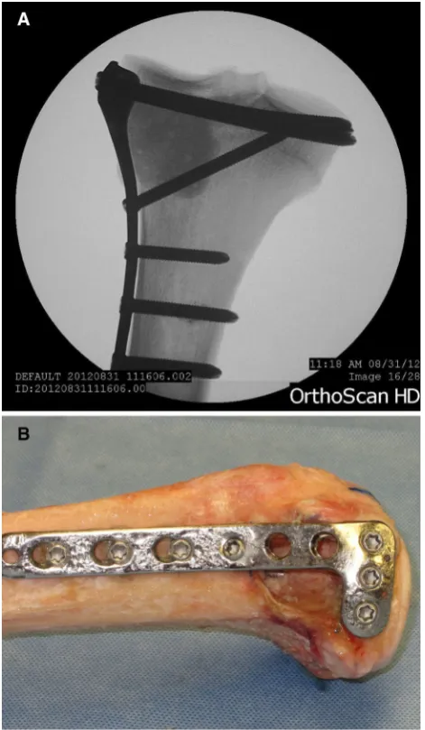 Fig. 1 Radiograph after PMMA (a) and gross image before PMMA(b) of reconstruction with a locking plate