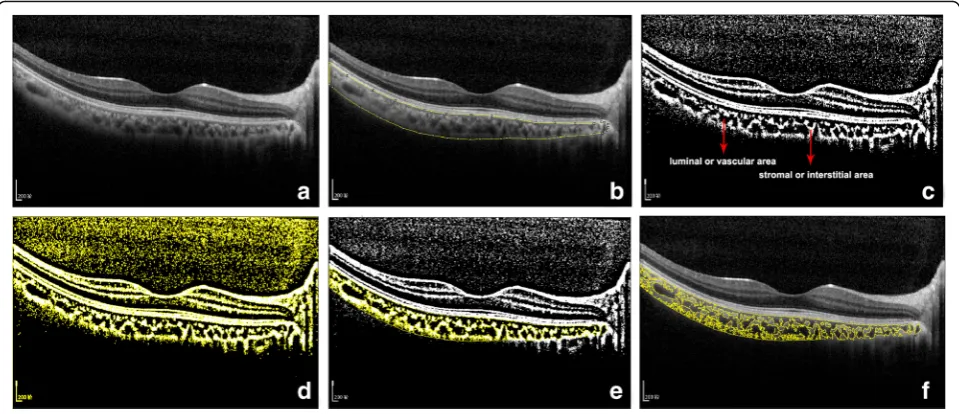 Fig. 1 Image binarization for choroid with Niblack auto local thresholding technique. a Original EDI-OCT scan image