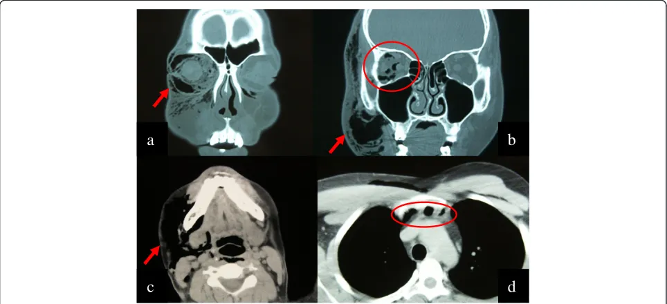 Figure 3 An emergency computed tomography (CT) scan of the orbit, brain, neck, and chest