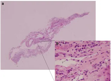 Fig. 1 Histology of excisedoccasional eosinophils (Cells with spindly nuclei andsurrounding fibroconnectivetissue identify the fibro-glialcomponent (epiretinal membrane from case1 (hematoxylin and eosin stain).a The membrane in its entirety,with abundant i