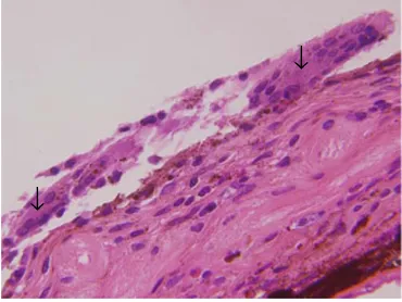 Fig. 6 Immunohistochemicalstaining of the ERM from case2, demonstrating apreponderance of histiocytesamong the inflammatory cellpopulation and out of thelymphocyte population, a slightpreponderance of T cells over Bcells (magnification, ×100)