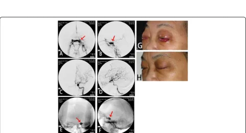 Fig. 3 The DSA and clinical symptoms before and after the embolization of right ICA cavernous sinus fistula.shows dilated draining of superior ophthalmic vein.opacified