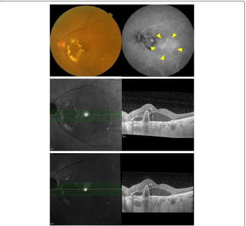 Table 2 Comparison of choroidal/foveal thickness and visual acuity between two groups