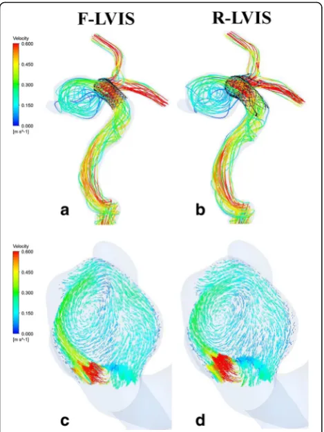 Fig. 2 Representative contours of velocity streamlines andreleased aneurysm (vectors at peak systole