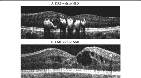 Figure 2 Spectral domain OCT shows diffuse retinal thickening (A) and hyporeflective cystic spaces in the inner retina suggestive ofcystoid macular edema (B) without any neurosensory detachment.