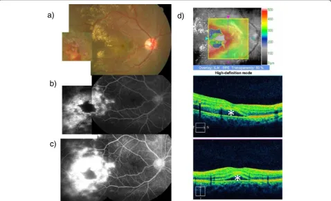 Figure 1 Case 1 at the initial visit. a)coherence tomography. Symbols indicate subfoveal serous retinal detachment site