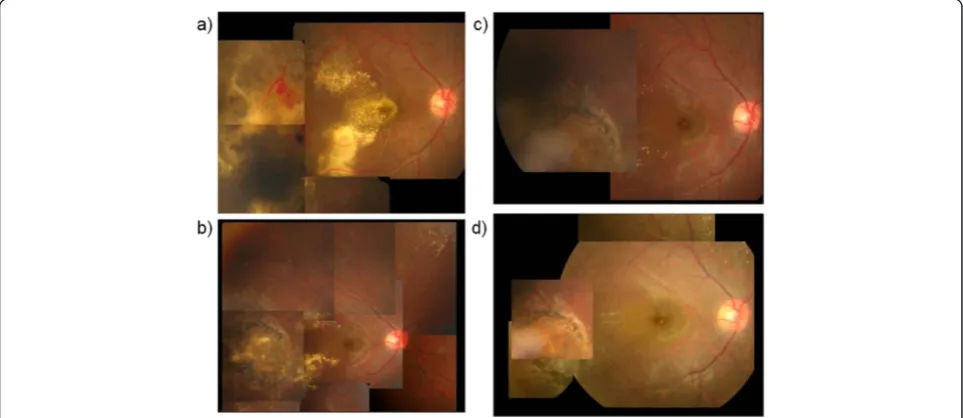 Figure 2 Case 1 fundus photographs. a) Prior to the injection of intravitreal bevacizumab (IVB)