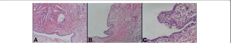 Fig. 3 Saggital T2 (Left and Middle image) and post contrast (Right image) demonstrating the cranio-caudal extension of the lesion.Inferiorly lesion is buckling the optic chiasma and tegmentum of midbrain