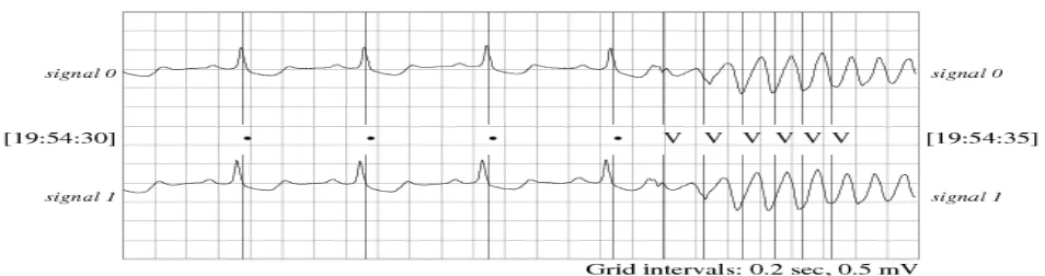 Figure 3. A ventricular tachycardia condition for first 5 seconds. 