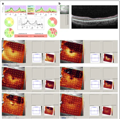 Fig. 2 On spectral domain optical coherence tomography (SD OCT), a superotemporal peripapillary retinal nerve fiber layer (RNFL) defect wasnoted with intact papillomacular bundles