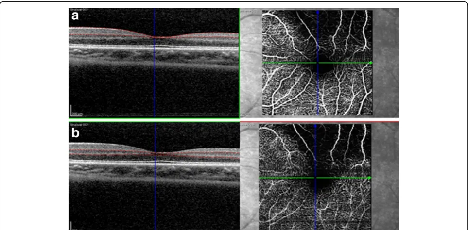 Fig. 3 On optical coherence tomography angiography, a focal attenuation of superficial and b intermediate/deep capillary plexuses weredetected in the corresponding areas of retinal thinning