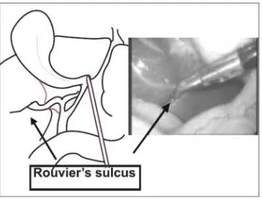 Figure 9: Rouviere’s sulcus 