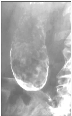 Figure 17A: Plain radiograph showing         Figure 17B: Porcelain gall bladder  