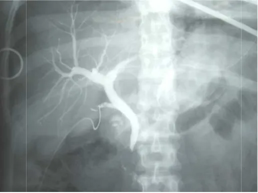 Figure 19: Normal intraoperative cholangiogram. Contrast can be seen clearly Figure 19: Normal intraoperative cholangiogram
