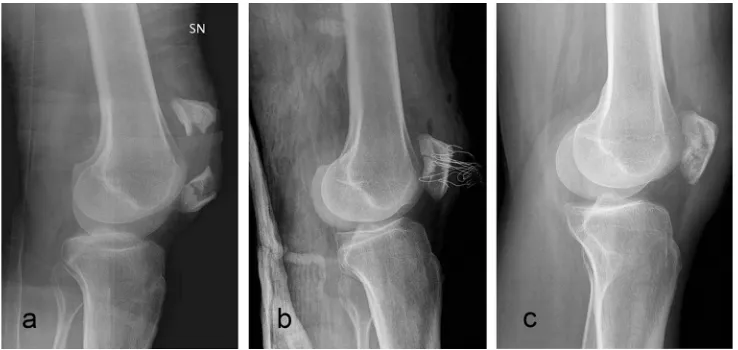 Fig. 2 Comminuted patellar fracture. Preoperative X-ray (a); postoperative X-ray (b); ﬁnal follow-up X-ray (c)