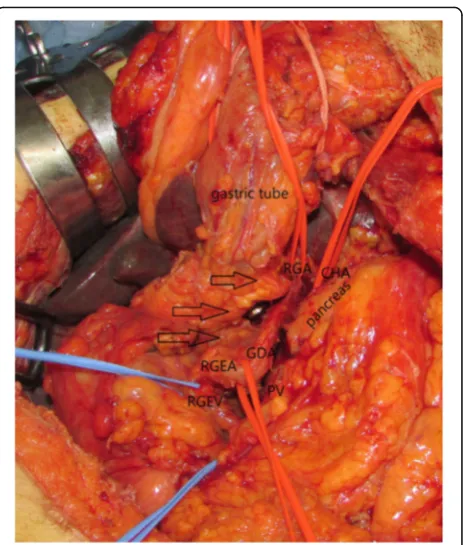Fig. 3 3D-CTA revealed that the gastric tube was the feeding vesselto RGEA branching from GDA