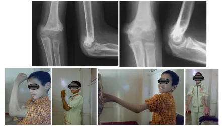 Fig. 10 The patient with iatrogenic re-fracture after complete unionand remodeling with loss of more than 30� of motion, denoting a fairresult according to the criteria given by Mark et al