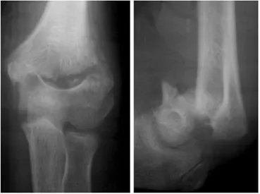 Fig. 2 X-ray of a patient with ﬂexion-type supracondylar fracture humerus neglected for 22 days showing off-ending of the fragments withmarked anterior displacement of the distal stump with early callus formation (seen in antero-posterior view) (patient 14)
