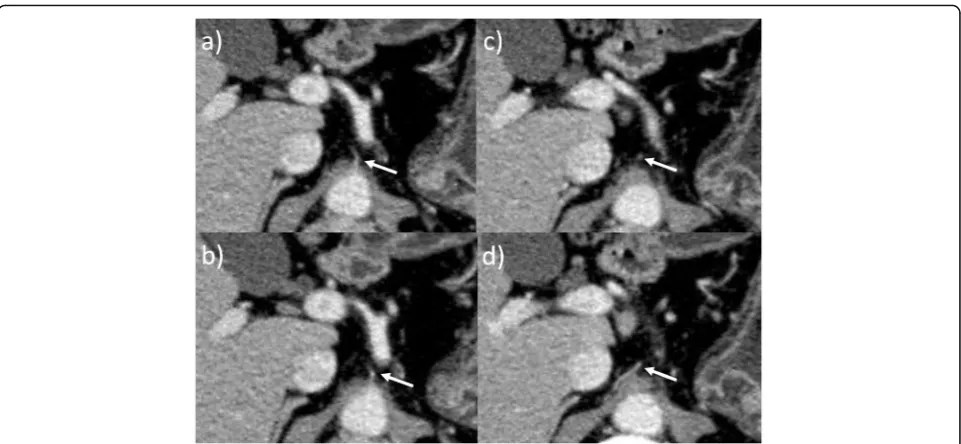 Fig. 4 Preoperative CT. a The RIPA (arrow) originated from the aorta without a common trunk