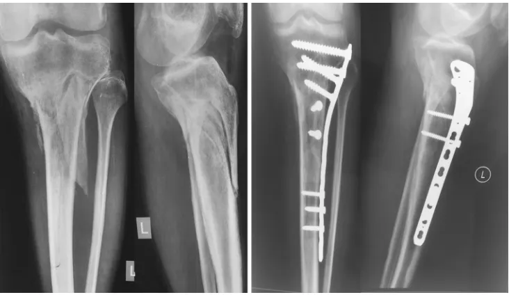 Fig. 1 Patient with a segmental tibial fracture treated with expert tibial nail, showing a good range of motion of the knee postoperatively