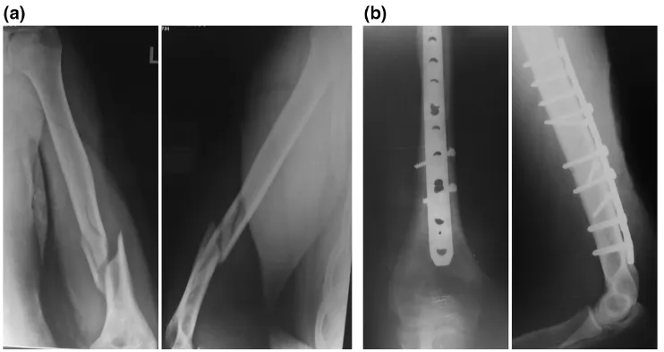 Fig. 3 a Anteroposterior and lateral views showing a distal-third fracture with medial comminution and proximal extension of the fracture line.b Post-operative anteroposterior and lateral views showing complete union at 4.5 months; only two locking screws are in the distal fragment