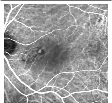 Figure 1 Typical PCV. Neither feeder nor draining vessels were visiblein the early phase of indocyanine green angiography