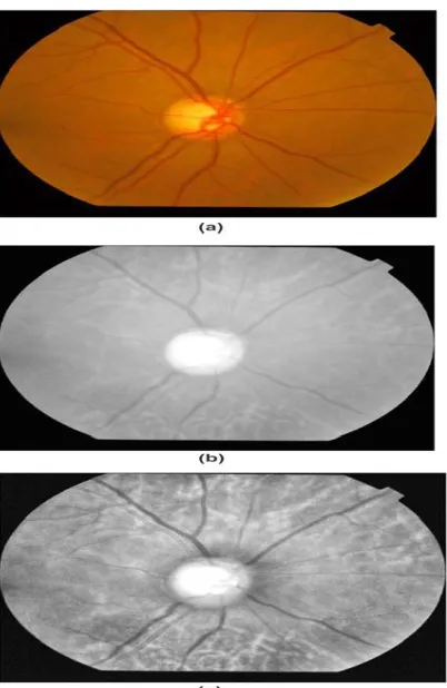 Fig. 6 (a) Raw retina image. (b) Corresponding red layer  /R .(c) CLAHE-enhanced image   