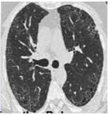 Figure 3.3 Chronic OPD 