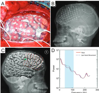 FIGURE 1Electrode implantation, localization, and control-feature determination (from subject 2)
