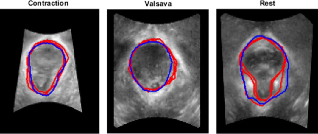 Fig. 4 Segmentation examples of the levator hiatus at the three different stages (contraction, Valsalva, and rest) using the proposed method (blue) compared to the outlines provided by the operators (red).