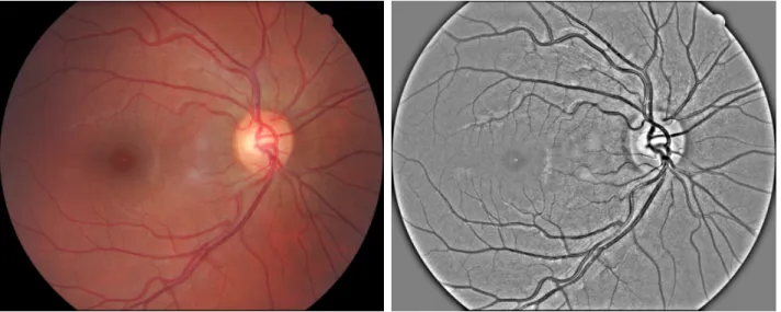 Figure 1. Example image from E-Ophtha dataset. From left to right: original image; preprocessed image.