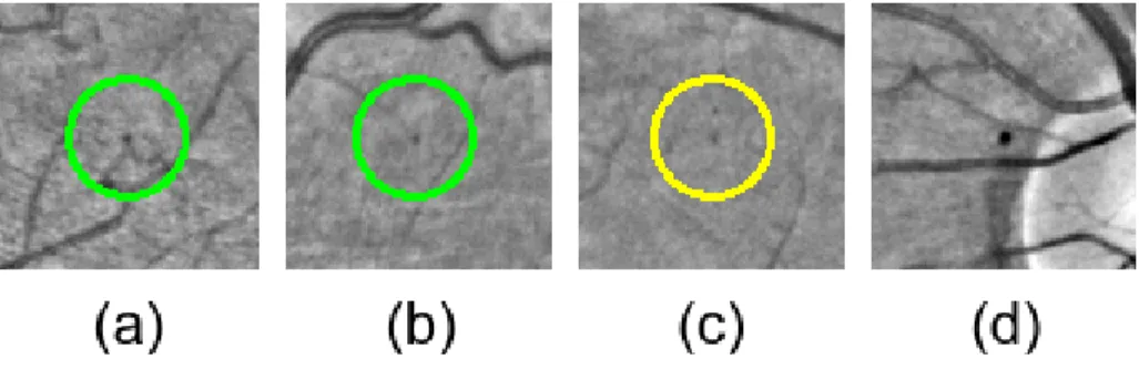 Figure 5: Detection results in presence of common challenges using image regions extracted from E-Ophtha and DIARETDB1