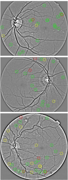 Figure 6: Examples of lesion detection results for E-Ophtha dataset. The probability threshold is set to 0.68 which corresponds to 61.86% per-lesion sensitivity and 1.08 average FPI rate.