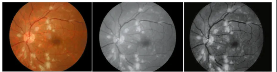 Figure 1 The pre-processing of original retinal image (left) in green channel (middle) and using adaptive histogram equationalgorithm (right).