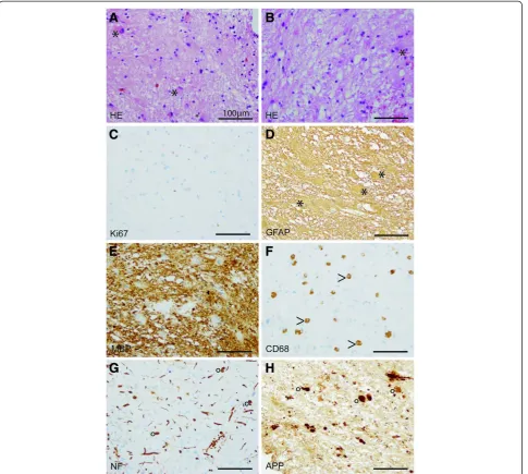 Fig. 4 Immunohistochemistry for CSFR1. CSFR1 immunohistochemistry of a stereotactic biopsy sample (a) and on tonsil (b), the latter serving aspositive control tissue (scale bares = 100 μm)
