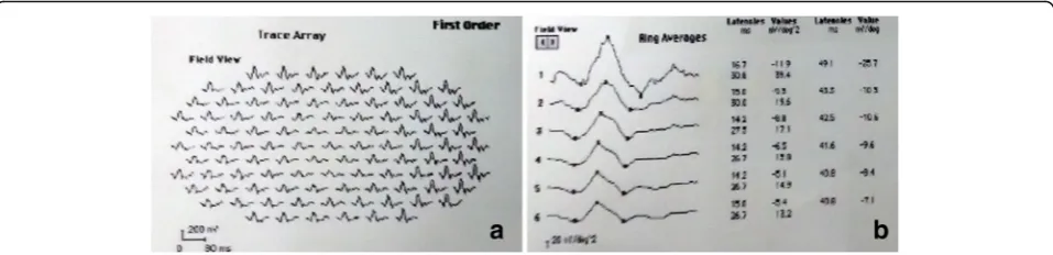 Fig. 1 Representative mfERG Images of a patient with idiopathic epiretinal membrane.projected onto the corresponding retina area.responses showed significant reductions in P1 response amplitude densities in ring 1 a The first order trace array: the 103 hex