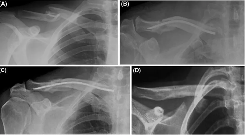 Fig. 1 a Preoperative X-ray of 32-year-old female patient showing displaced midshaft clavicle fracture right side