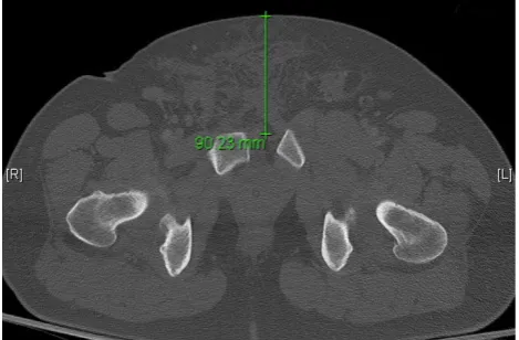 Fig. 4 Axial CT image of an obese patient who had a complicationfollowing vertical midline skin incision