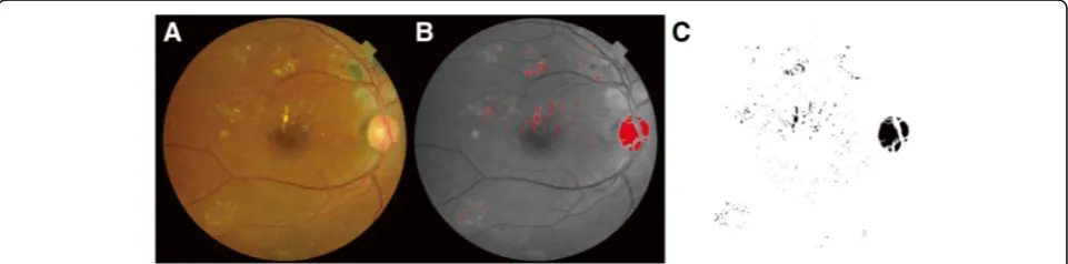 Fig. 1 Quantitative assessment of hard exudate (HE) area using ImageJ software. Color fundus photographand the total area covered by HEs was extracted from the green channel image using an automatic threshold function a was split into three color channels b which was convertedinto an automatic measurement c after manually eliminating areas that did not represent hard exudates (e.g., optic disc)