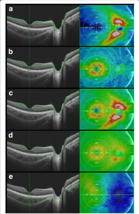 Fig. 2 Analyzed regions of retinal and choroidal thickness using theEarly Treatment Diabetic Retinopathy Study map