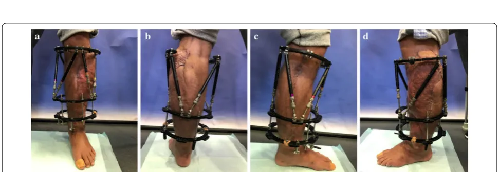 Fig. 6 Axial anterior external fixator for securing soft tissue coverage. a X-ray a.p