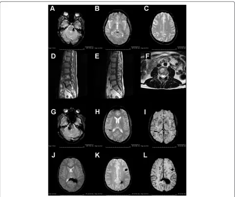 Figure 2 MRI findings.angiomas with involvement of the splenium of the corpus callosum, periventricular parietal white matter, head of the caudate nucleus, bilaterally,angiomas