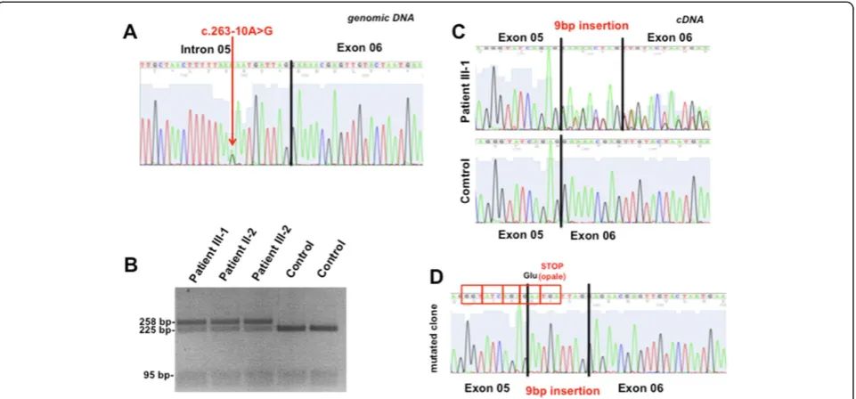 Figure 3 Molecular studies. (A)substitution.molecules, leaving mutated alleles uncut.proband Sequence electropherogram of proband’s (III-1) genomic DNA, showing the c.263-10A > G heterozygous (B) PCR-RFLP analysis of the c.263-10A > G mutation in affected 