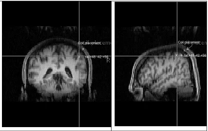 Figure 1: Coronal (left) and Sagittal (right) view for one participant 