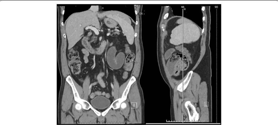 Fig. 4 The small bowel feces sign. On further inspection, the patient’s CT scan was determined to have a characteristic small bowel feces sign inthe mid-jejunum, just proximal to the suspected transition point