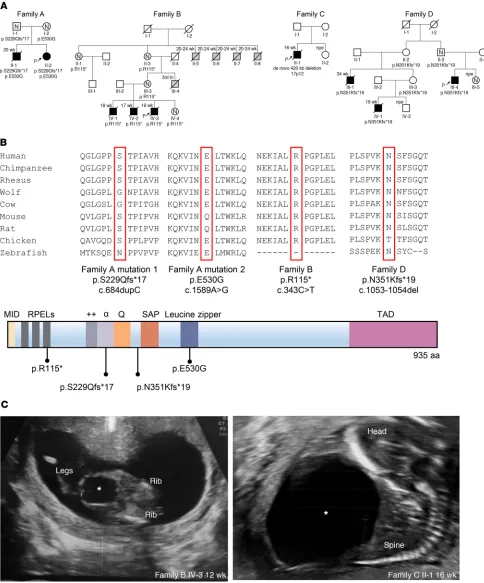 Figure 1. Identification of MYOCD variants in 4 families with congenital megabladder. (A) Pedigrees of 4 families presenting with congenital megablad-der